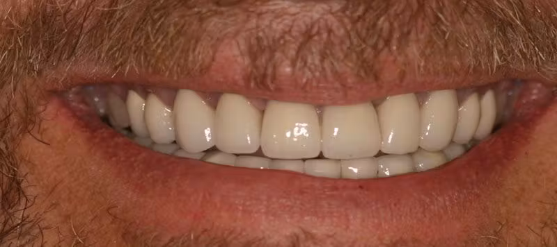 After Dental Implants