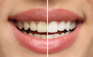 teeth whitening before-after