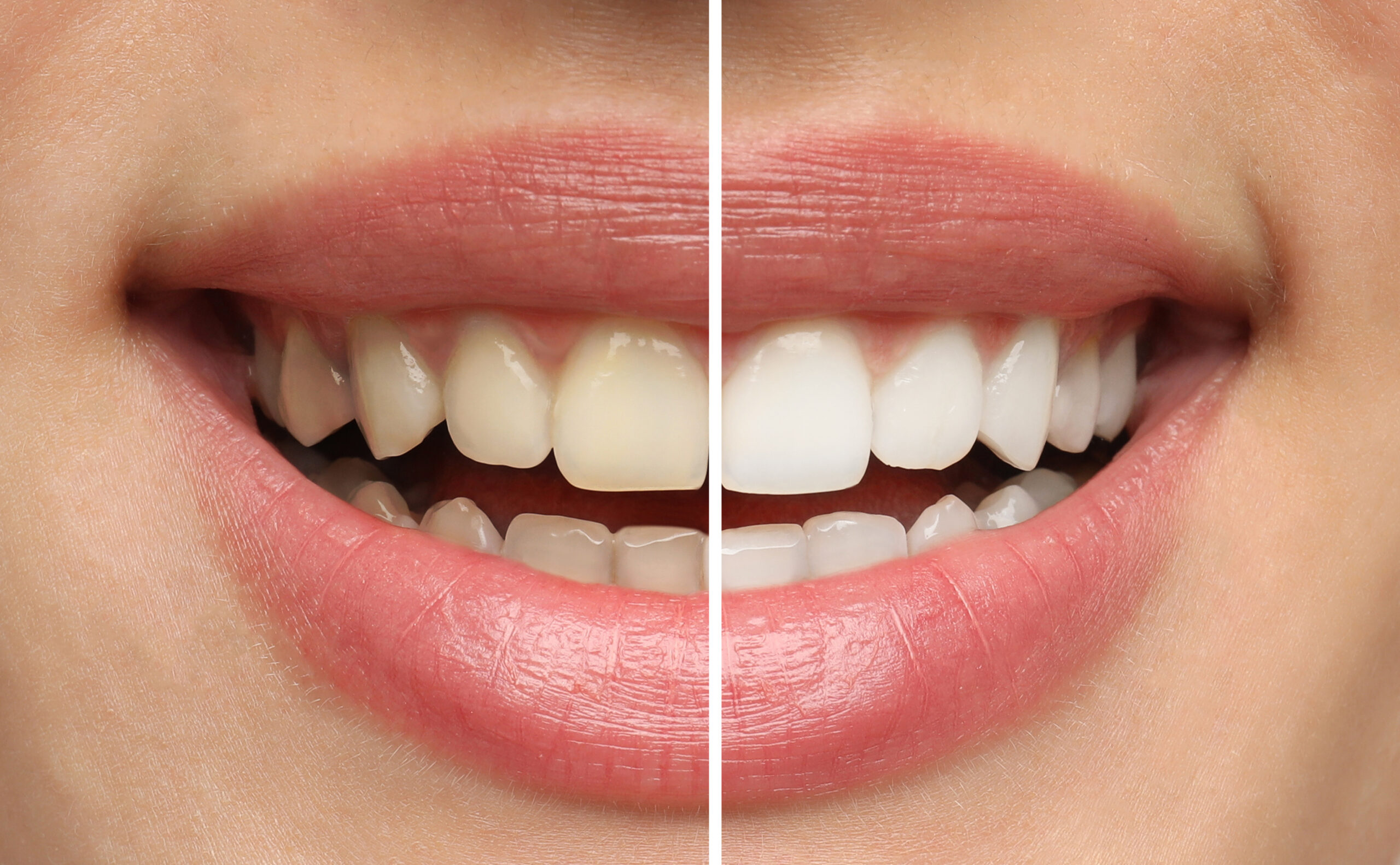 teeth whitening before-after