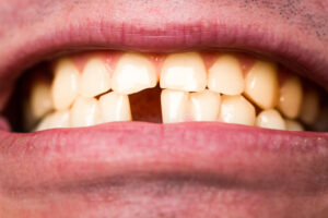 men with a lost front tooth