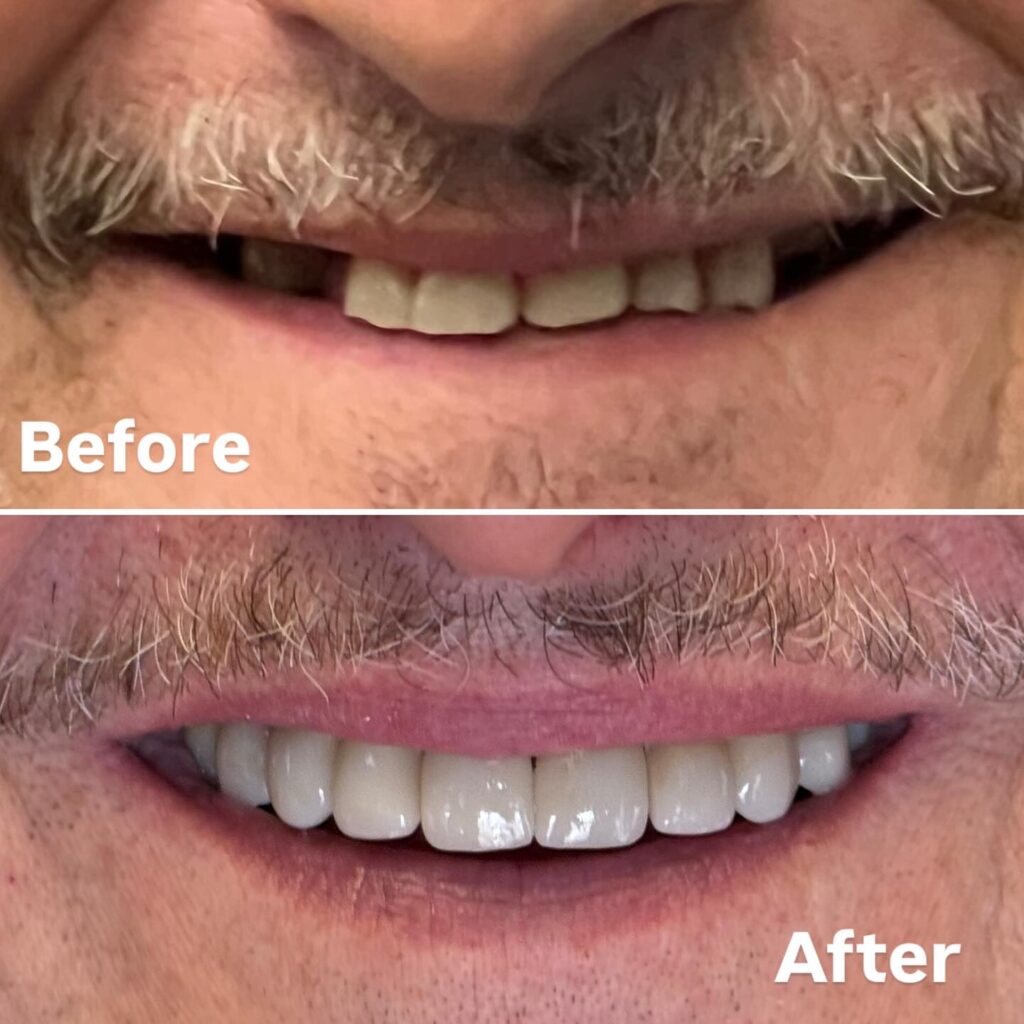 Before and after of a patient who received dental implants, splint therapy, and individual ceramic crowns
