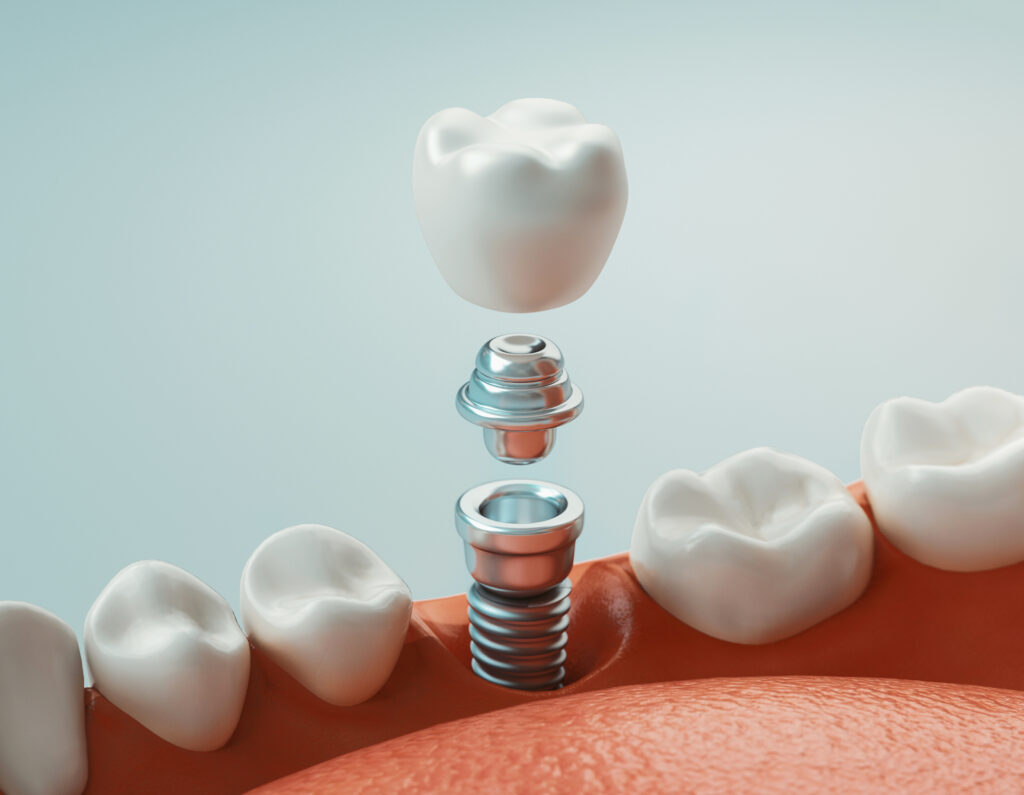 Dental implant, 3d rendering