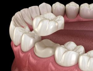 Preparated molar tooth for dental crown placement. Medically accurate 3D illustration