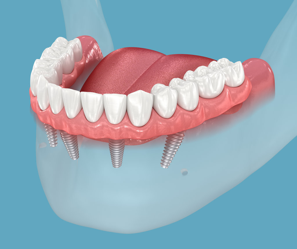 Mandibular prosthesis console based on 4 implants. Medically accurate 3D illustration of human teeth and dentures concept