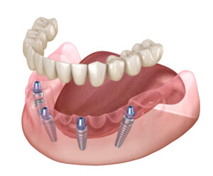 Mandibular prosthesis All on 4 system supported by implants. Medically accurate 3D illustration of human teeth and dentures concept