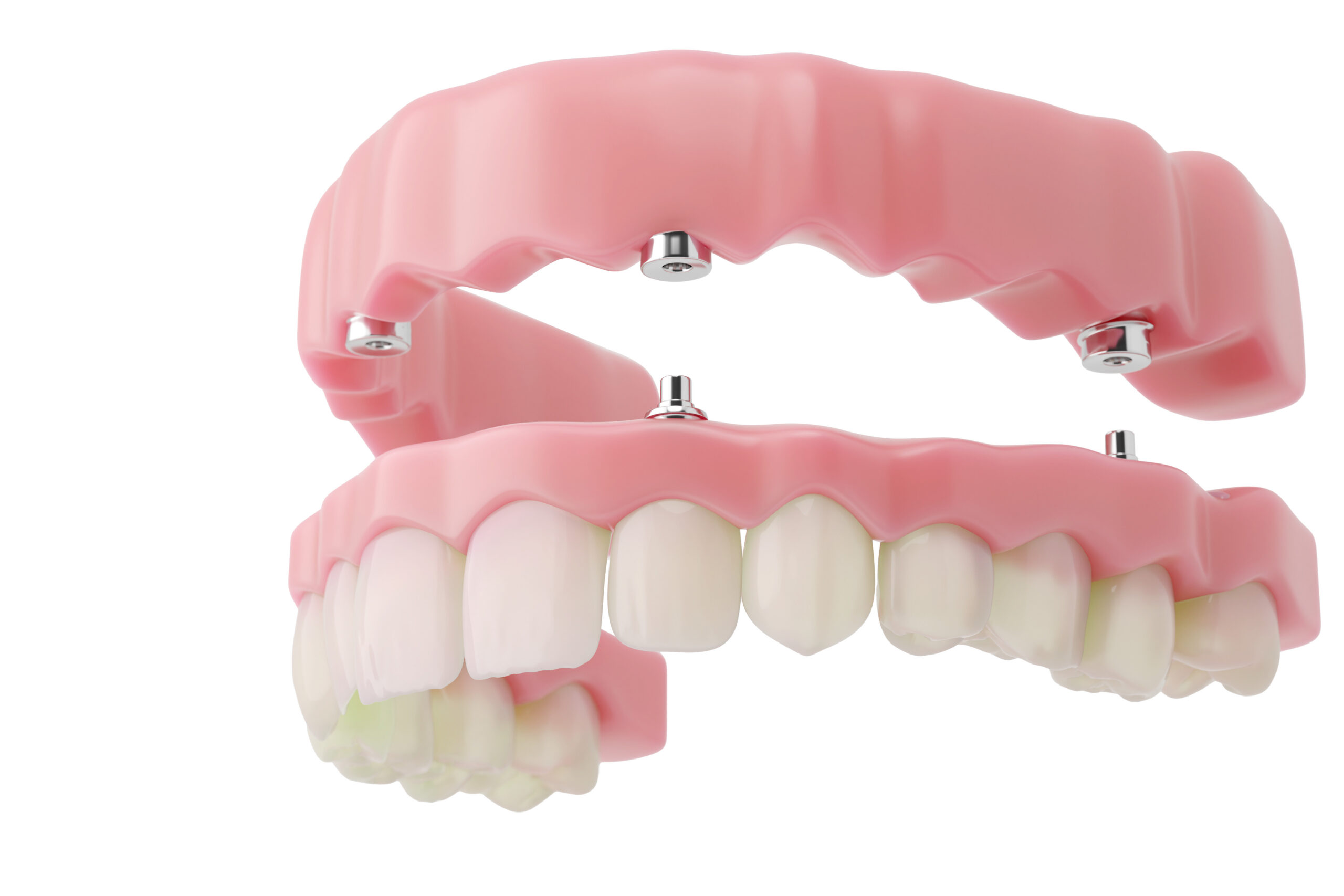 full dental implant showing fixed gum-supported prosthesis. 3D illustration