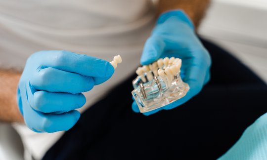 Close-up of a dental implant model showing the titanium post and crown placement in the jaw